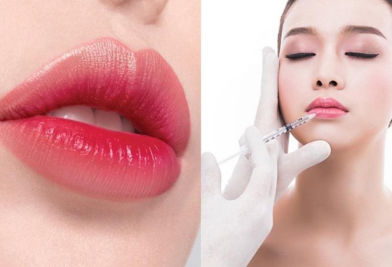 Tiêm filler môi giữ được bao lâu? Những lưu ý bạn cần biết trước khi tiêm